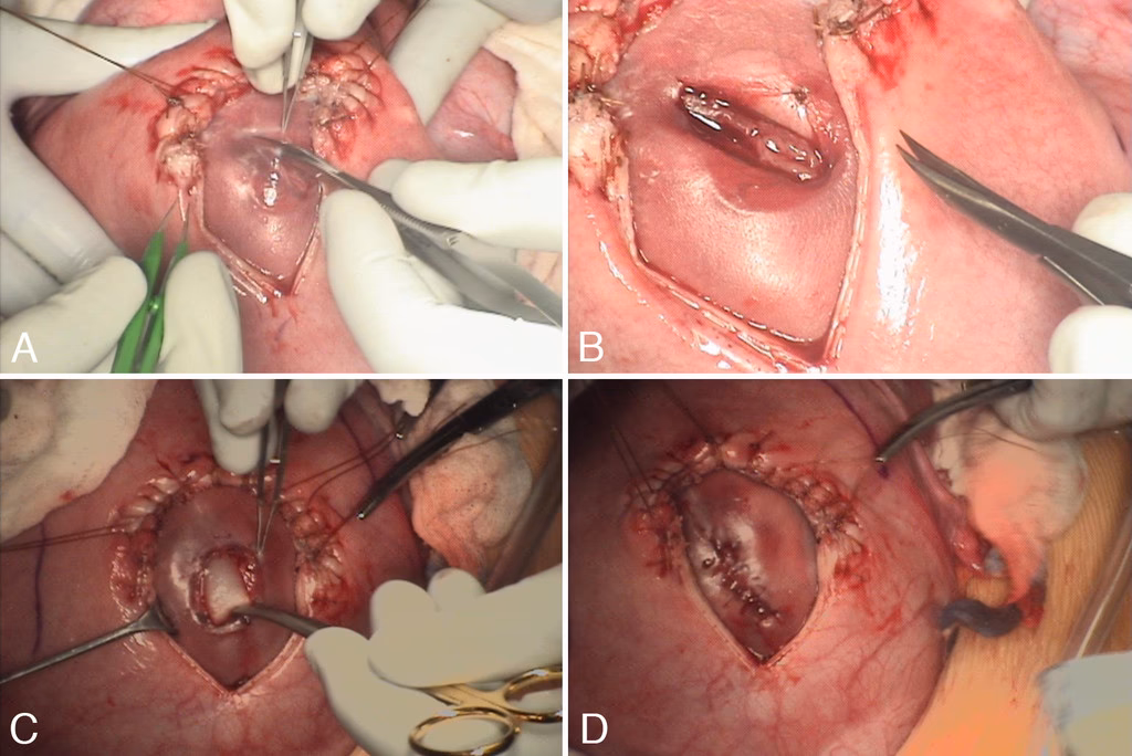 Do patients with spina bifida undergo surgery?