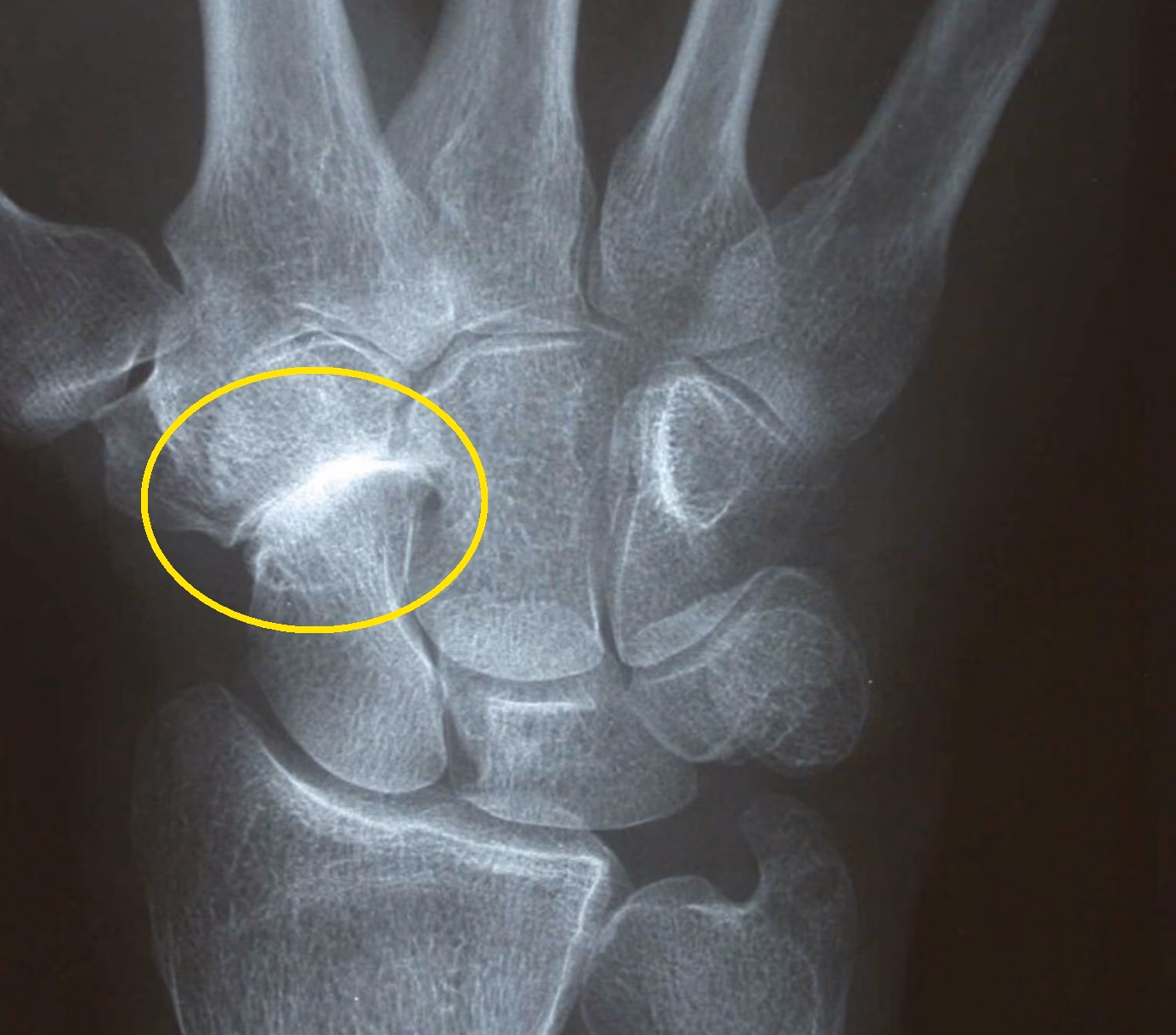 What is degenerative arthritis at the articulation of the STT?