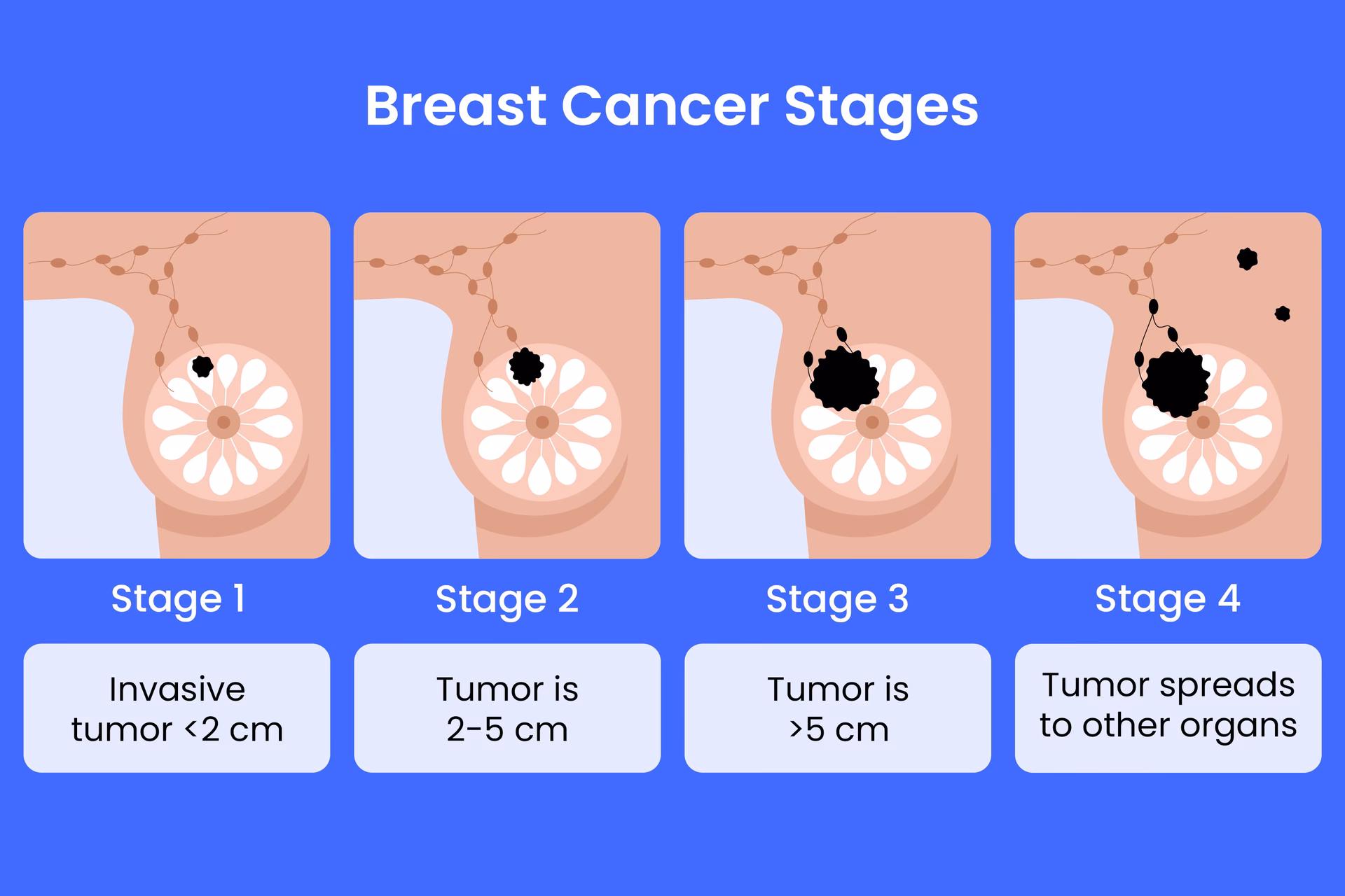 Does stage 0 breast cancer need treatment?