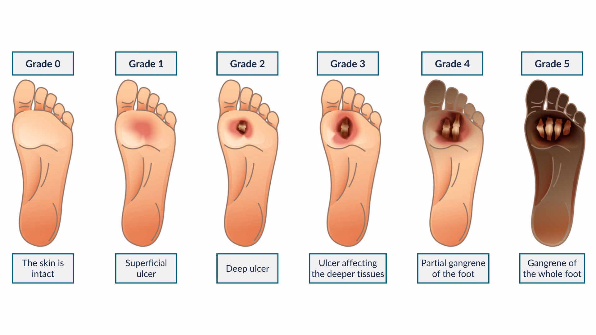 What are the stages of diabetes?