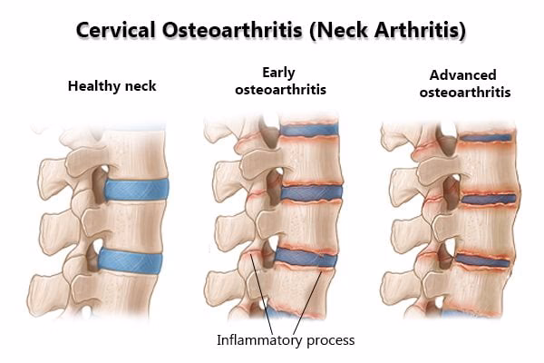 What is osteoarthritis in the neck?