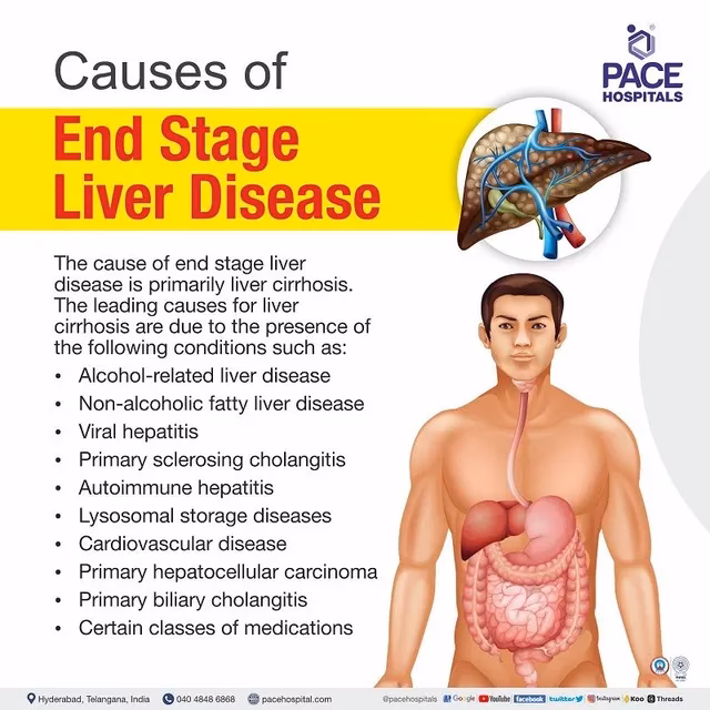 Can cirrhosis cause end-stage liver disease?