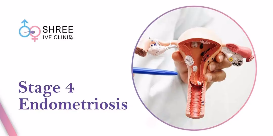 Do you qualify for Stage 4 endometriosis?