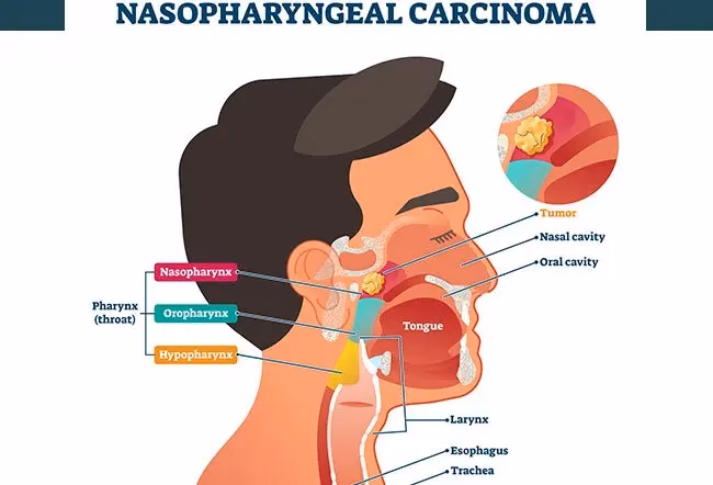 How do you know if a cold is Stage 2?