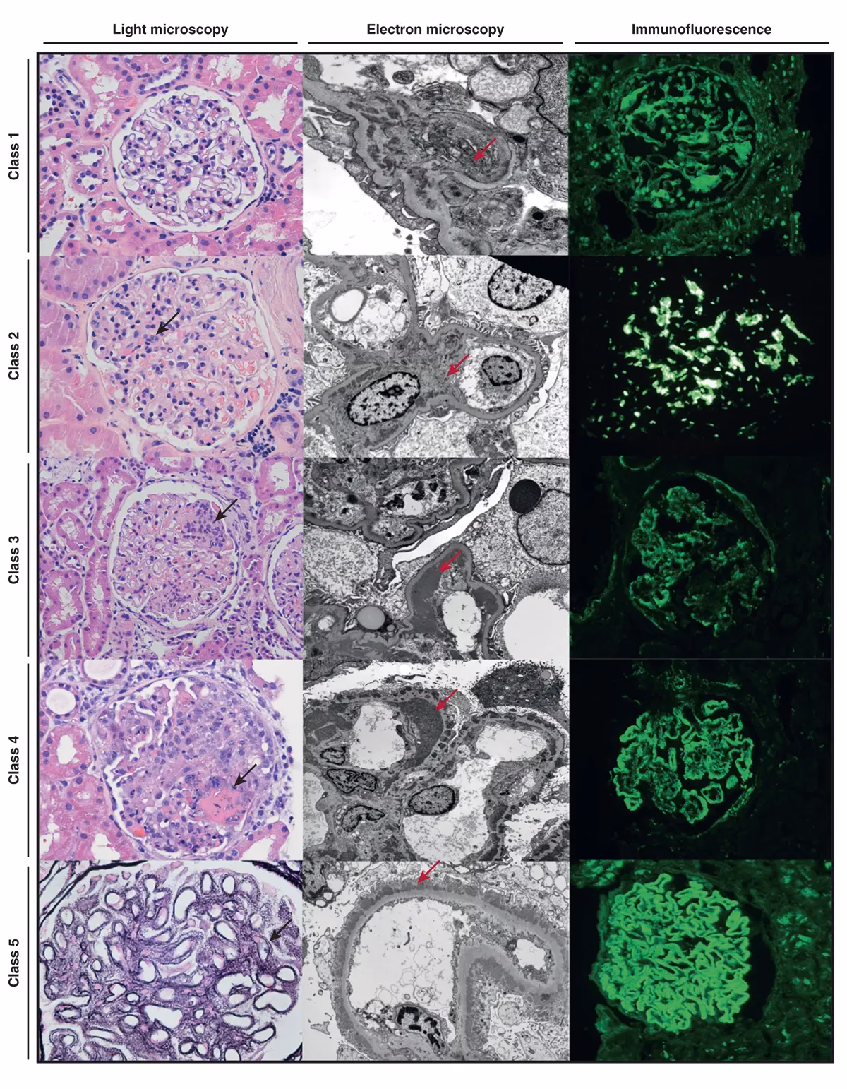 What is lupus nephritis (SLE)?