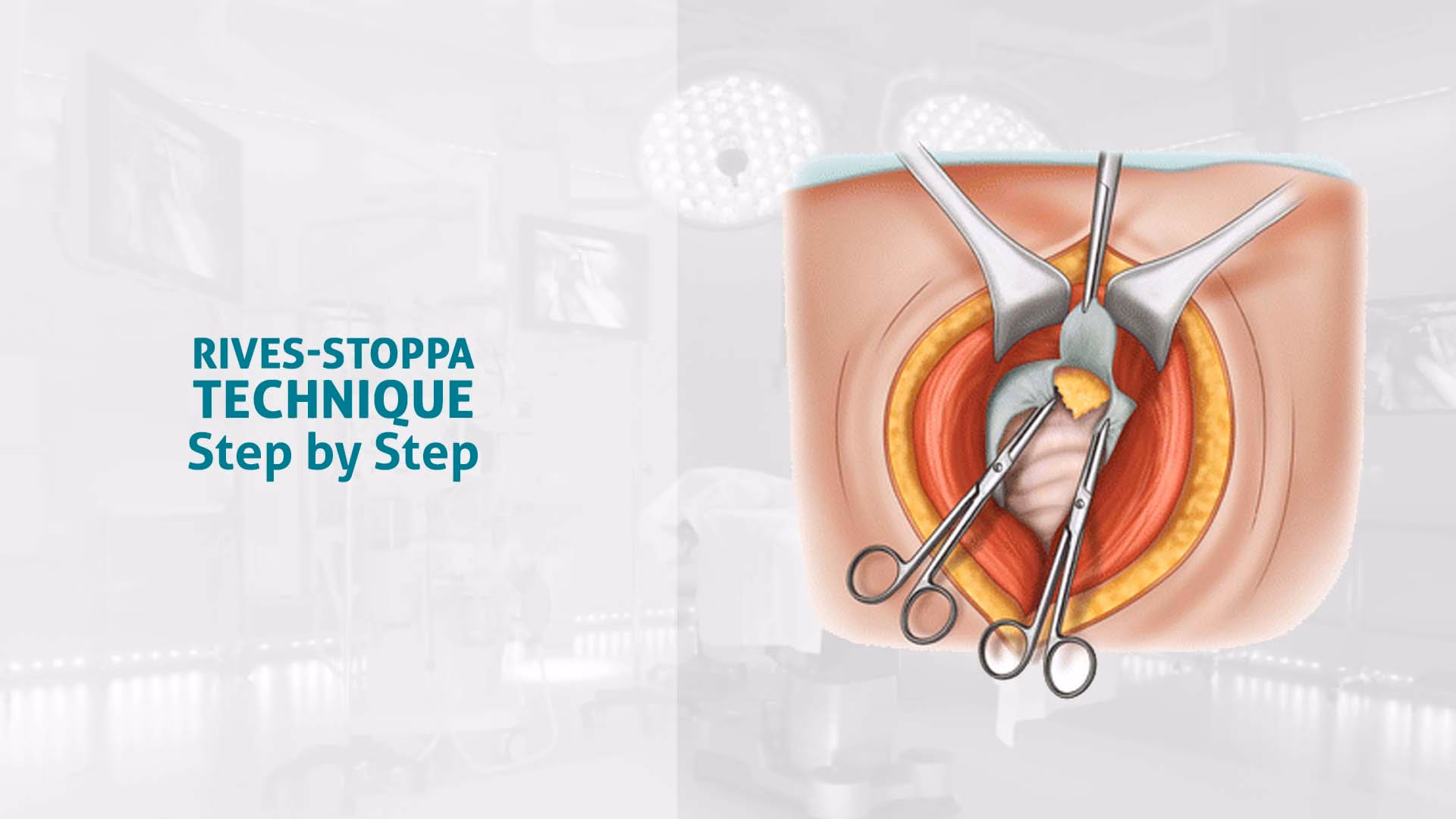What is a Stoppa & how does it work?