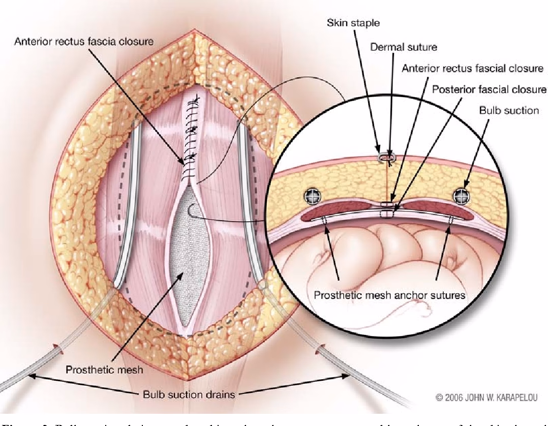 What is a Stoppa procedure?