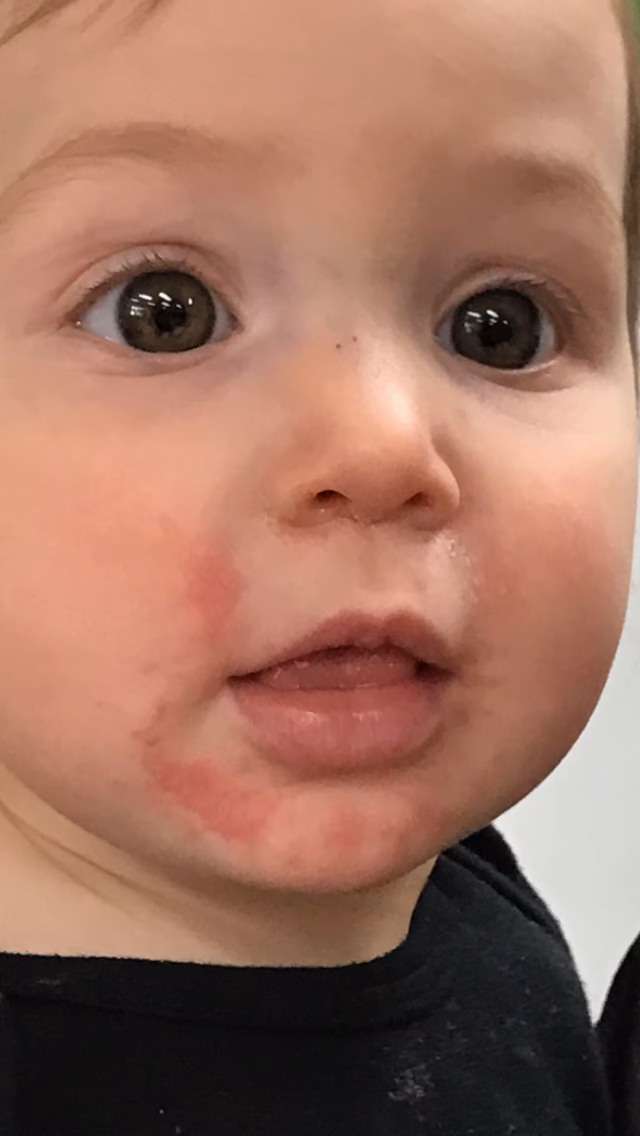 Do you have a strawberry allergy?