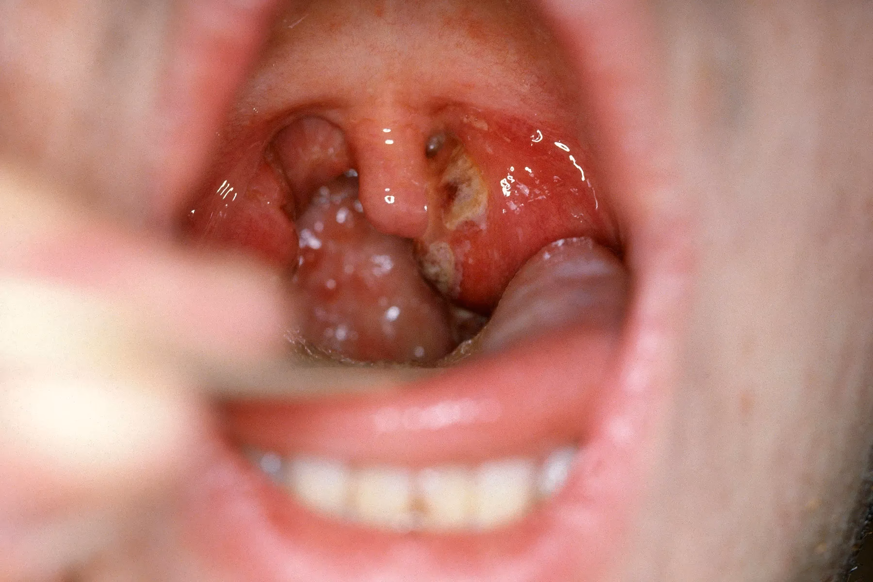 How do I know if I have strep C?