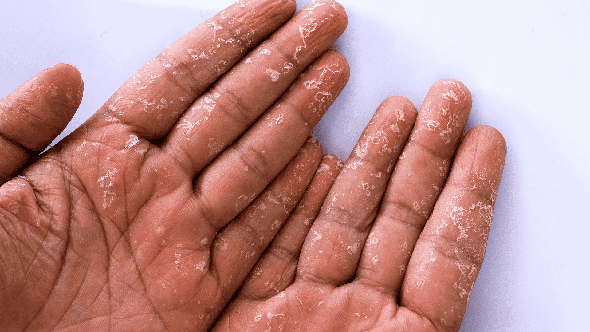 O que a bactéria Streptococcus pneumoniae pode causar?