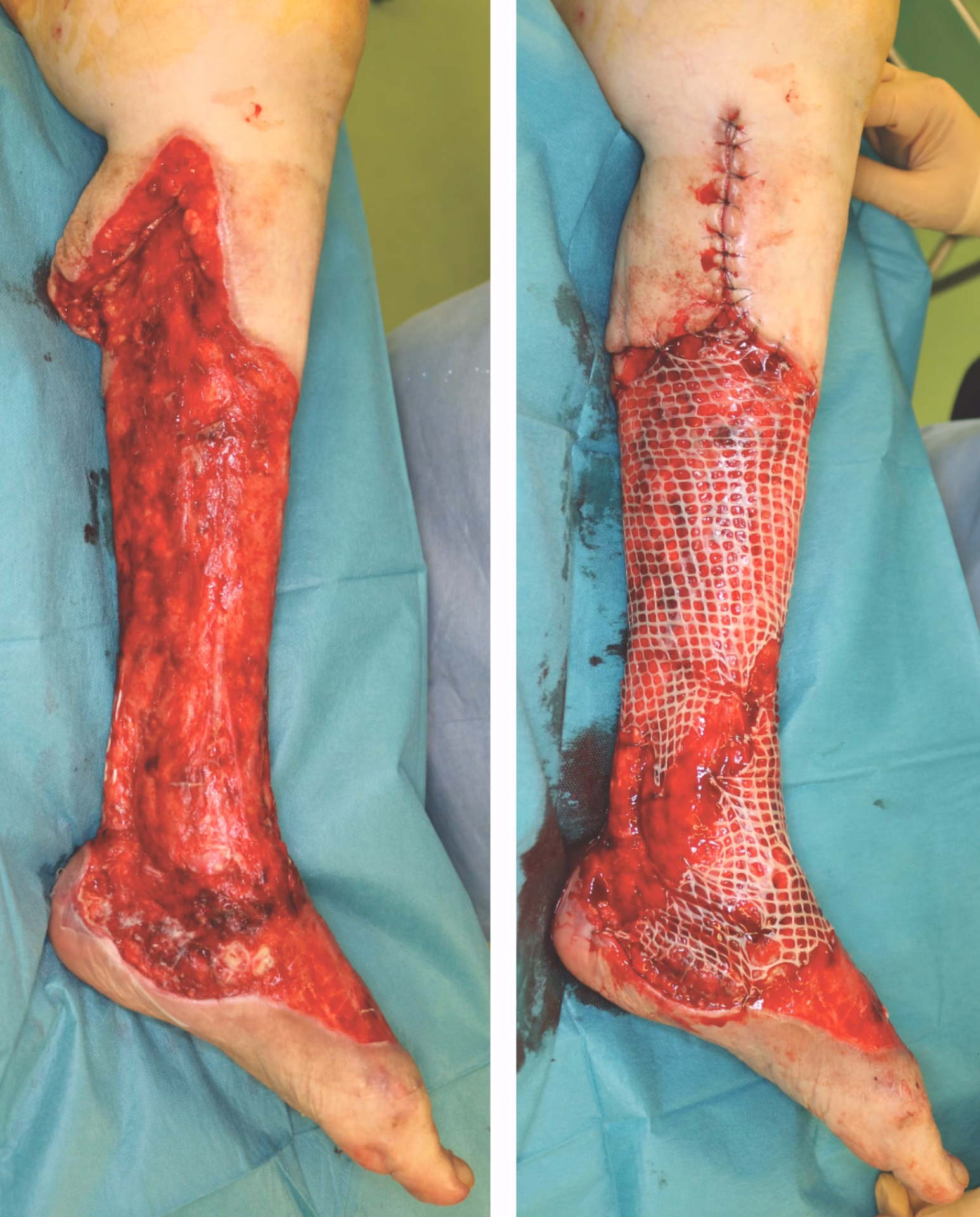 How is a streptococcal infection treated?