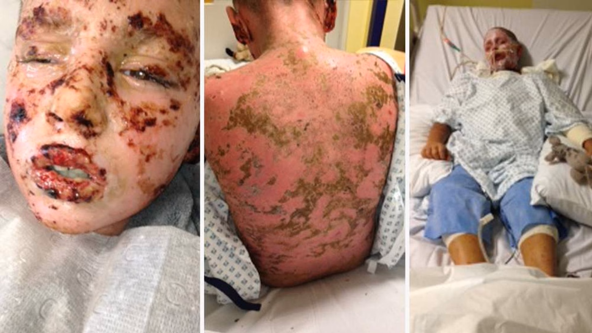 What causes hypersensitivity to ibuprofen?