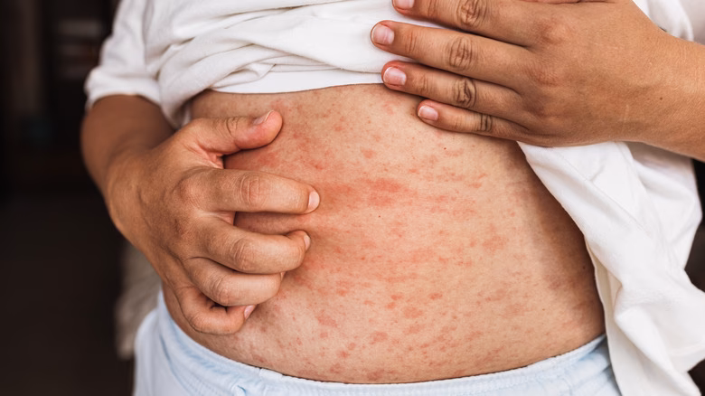 Can you drink white wine if you have a sulfites allergy?