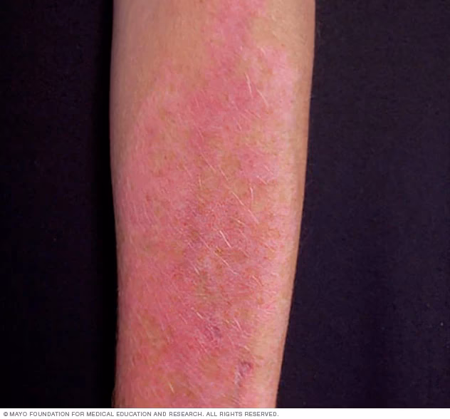 Can a sun allergy cause hives?