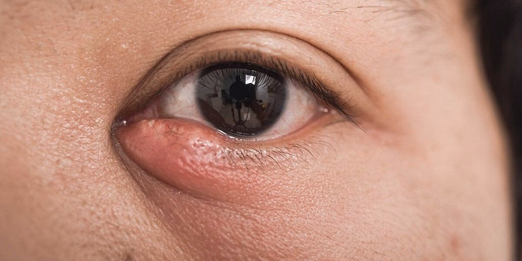 Can glaucoma cause a swollen tear duct?