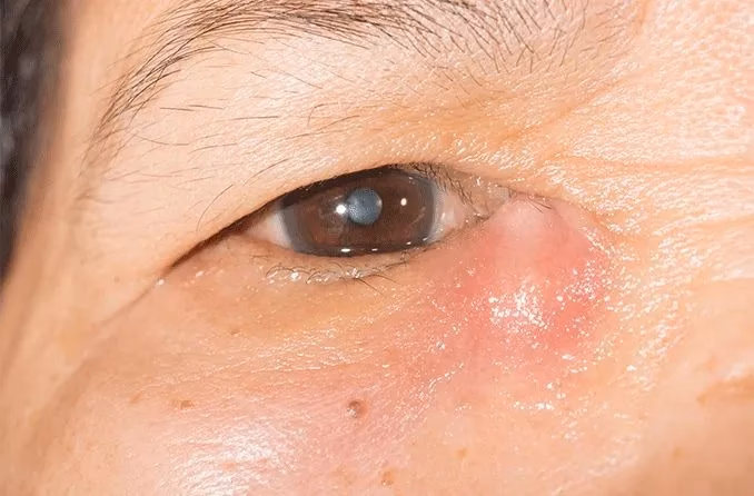 What causes itchy eyes after a tear?