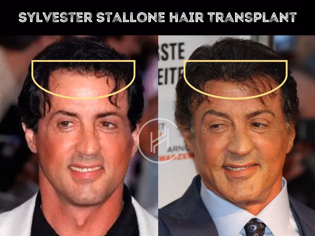 Did Sylvester Stallone recover from a 'Casino Royale' injury?