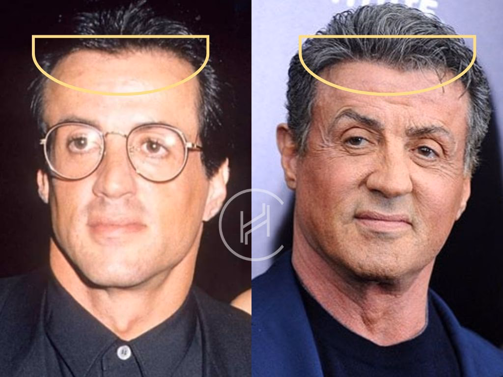 Did Sylvester Stallone recover from 'the Expendables' injury?
