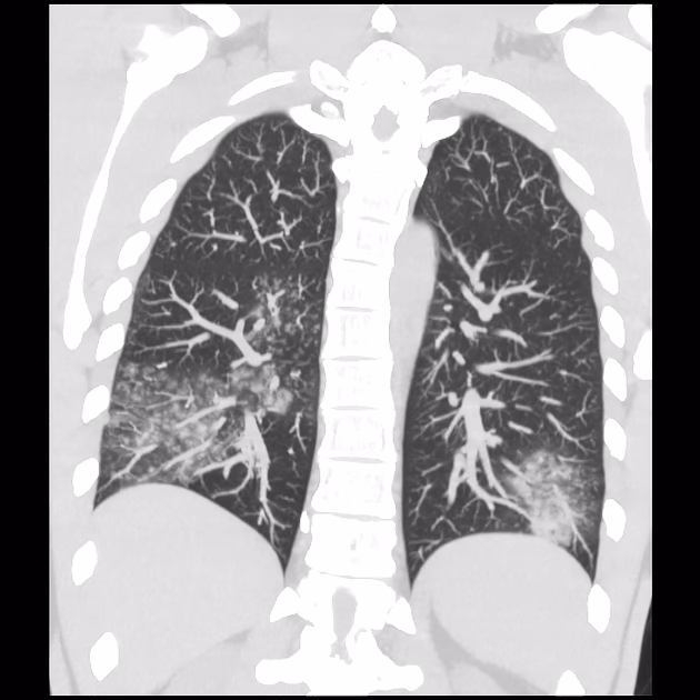 Can C pneumoniae be fatal?