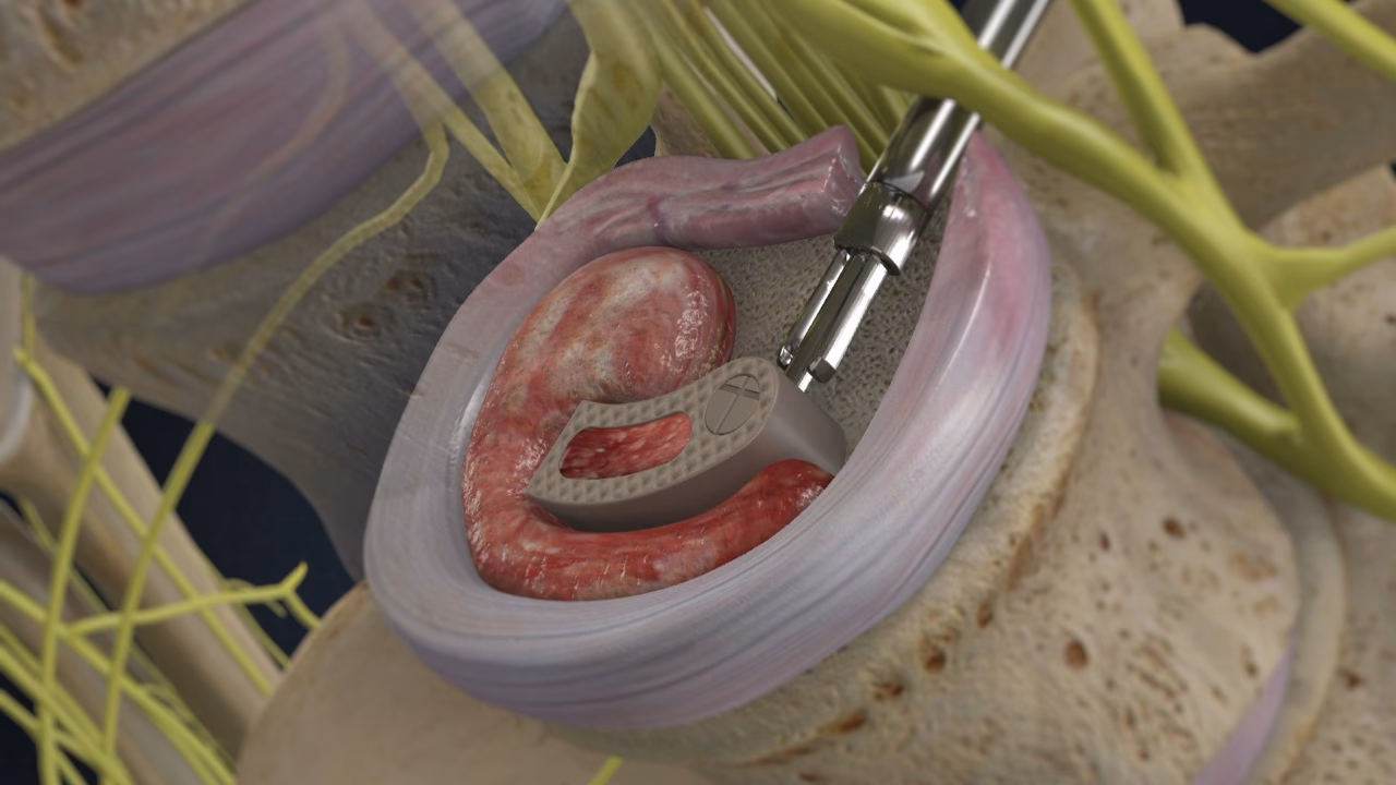 How does tlif surgery treat lower back pain?