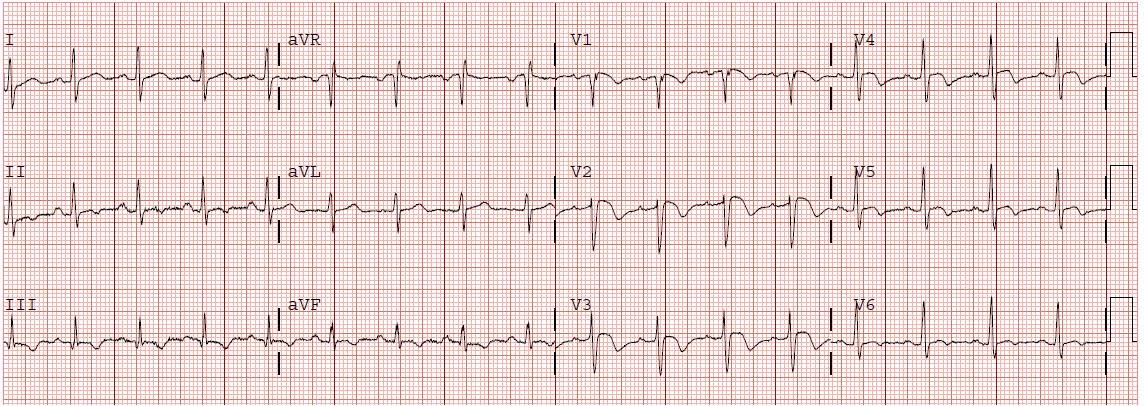 Which ECG abnormalities are more common in patients with severe anaemia?