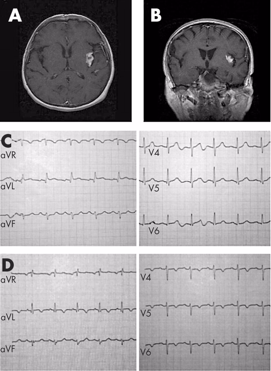 What electrocardiographic changes can be seen in patients with severe anaemia?