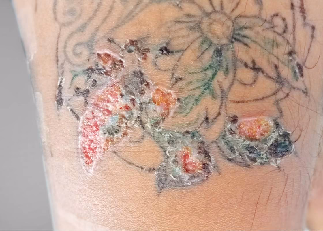 Was sind die Ursachen einer Allergie gegen die Handschuhe des Tätowierers?