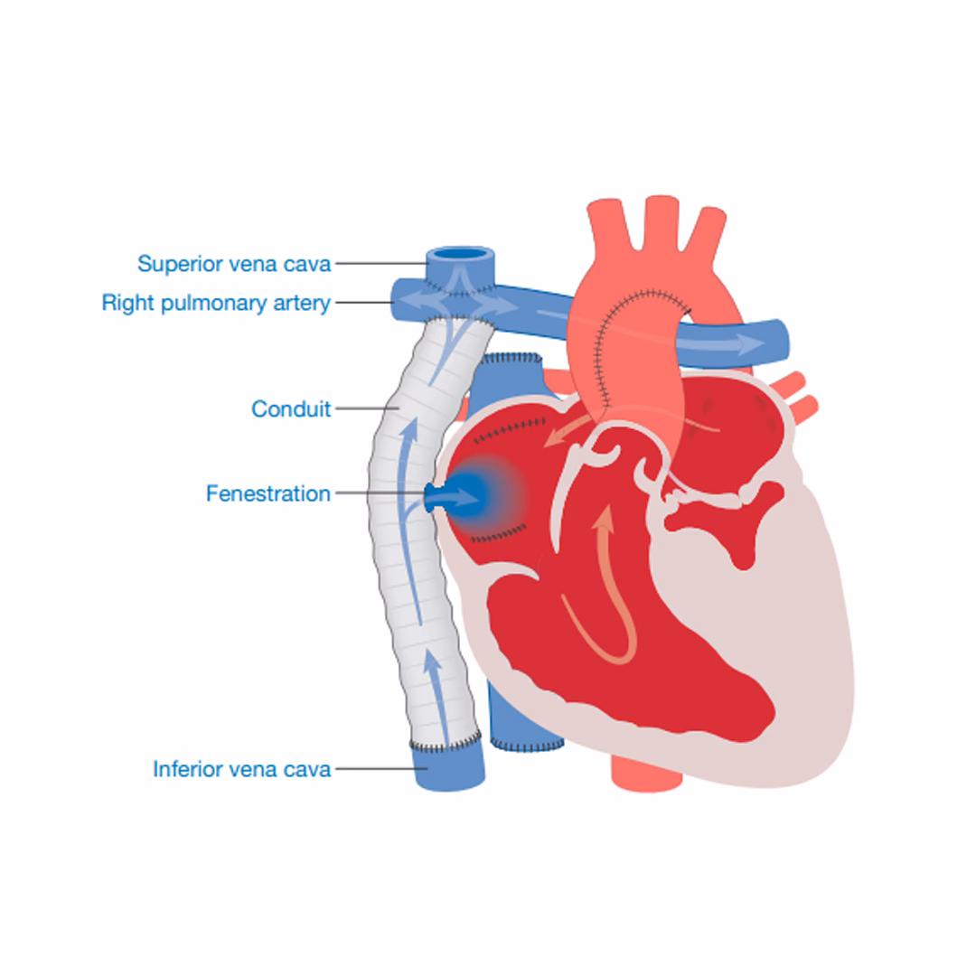 What is a TCPC surgery?