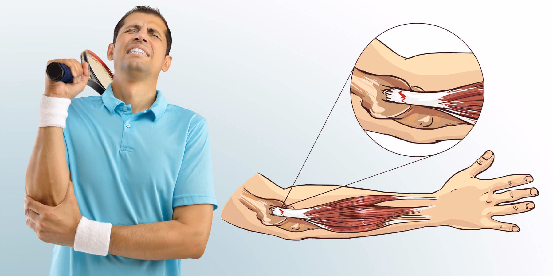 Wann sollte ein Tennisarm operiert werden?