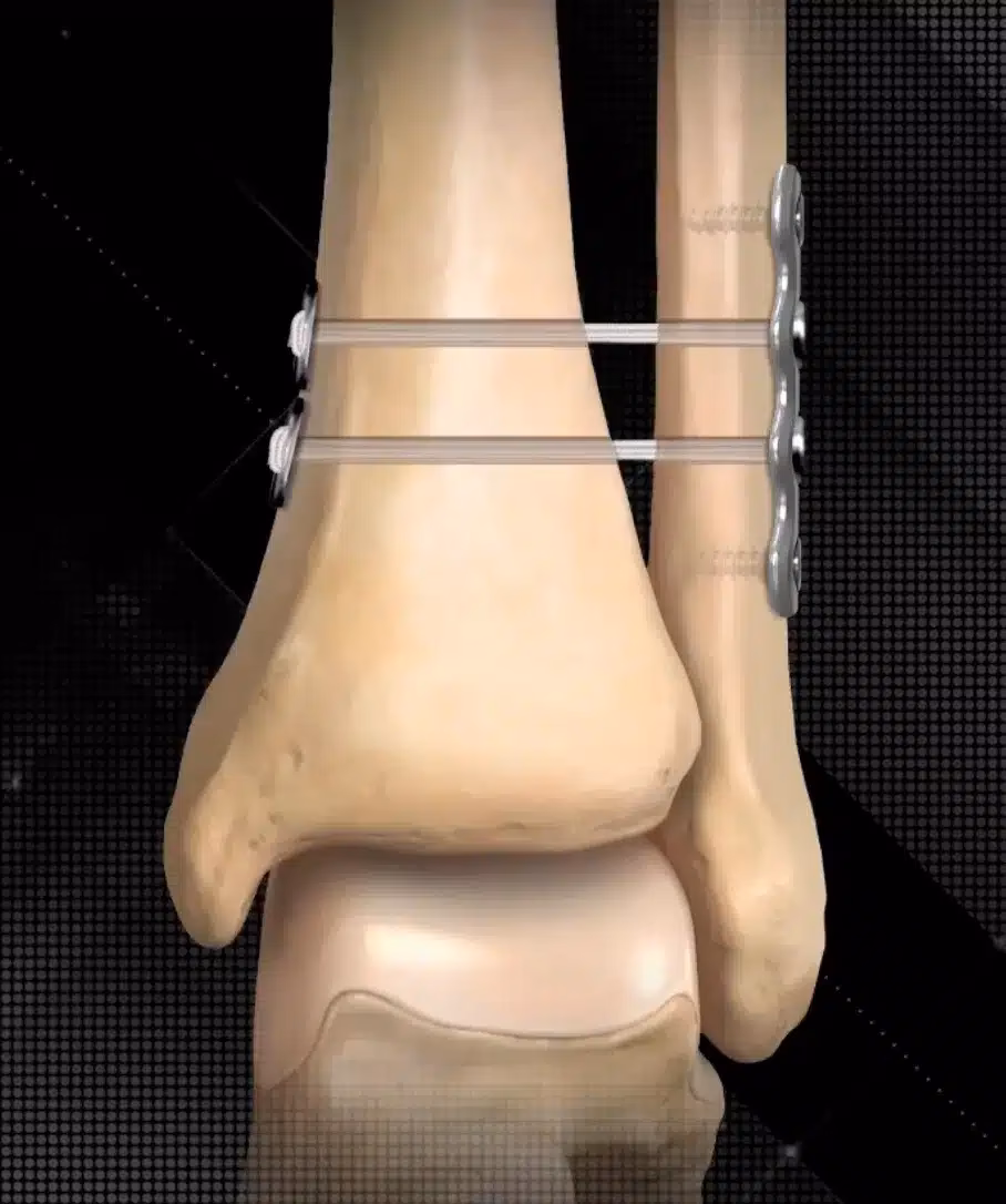 What is the tightrope procedure?