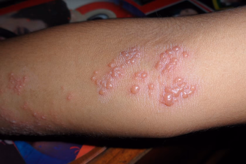 ¿Cuáles son los diferentes tipos de herpes?