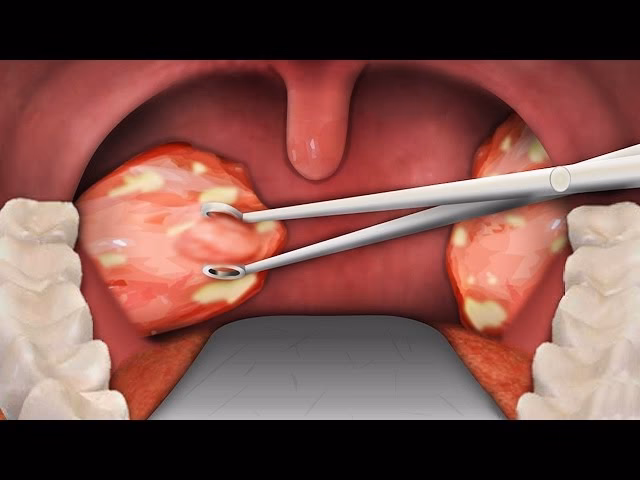 Can a tonsillectomy treat enlarged tonsils?