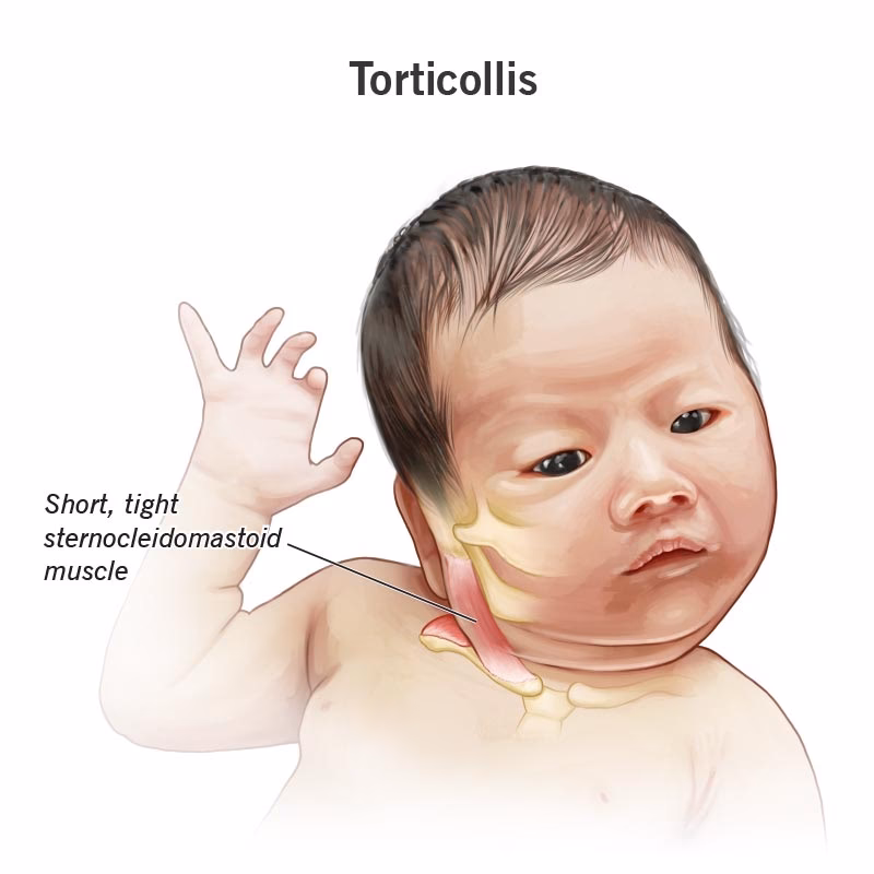 What causes congenital torticollis?