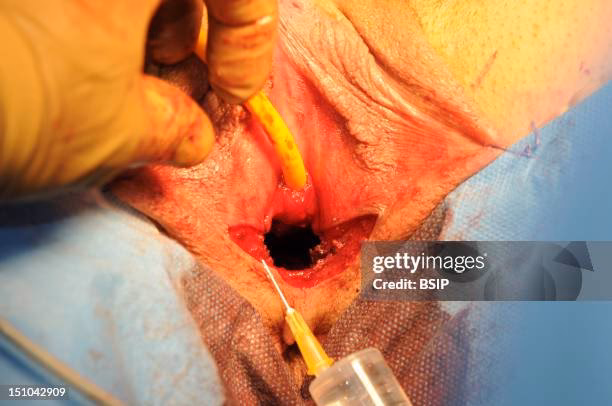 What surgery did a 34 year old transgender male have?