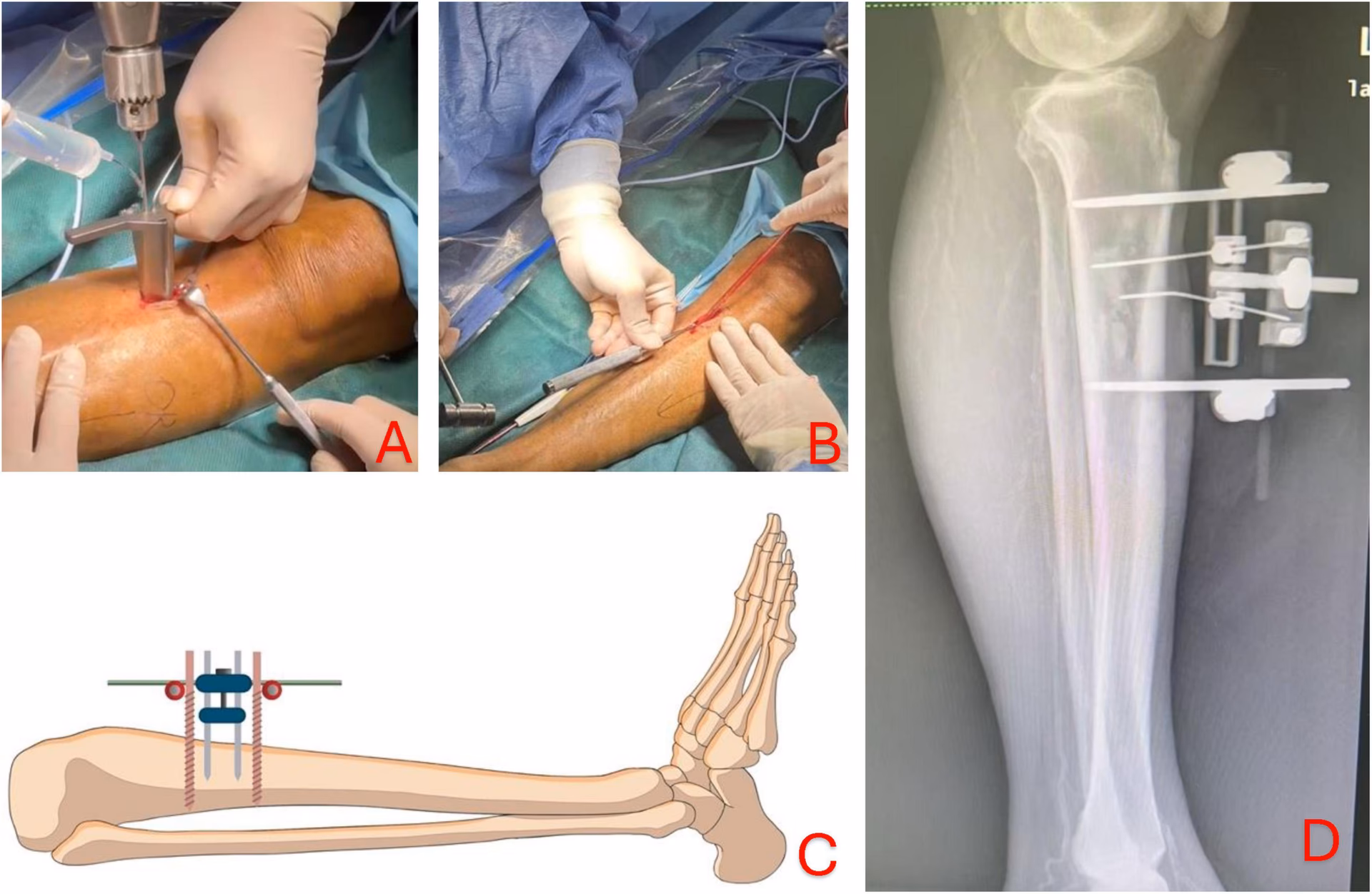 What is TTT for kneecap surgery?