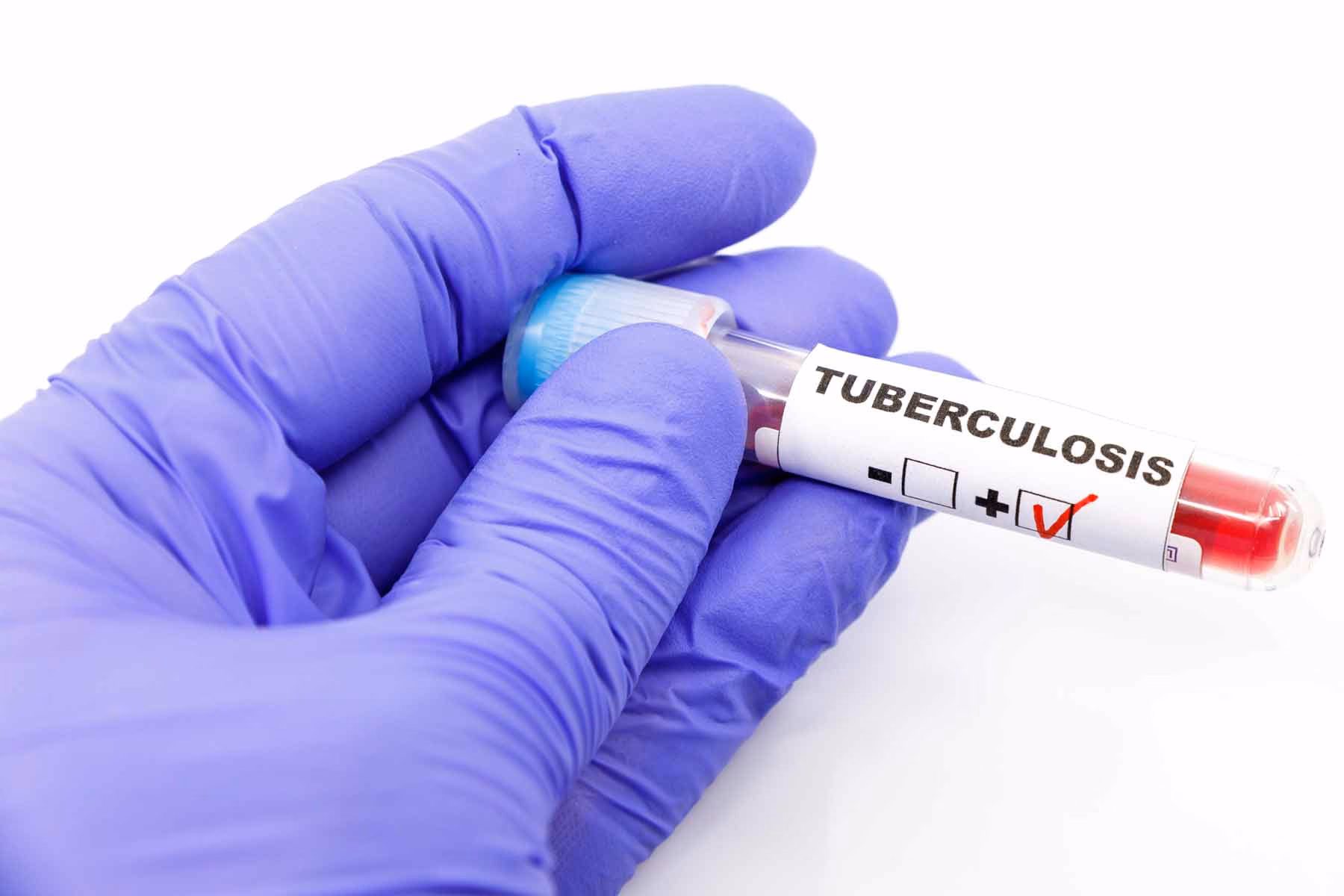 What does a negative TB blood test mean?