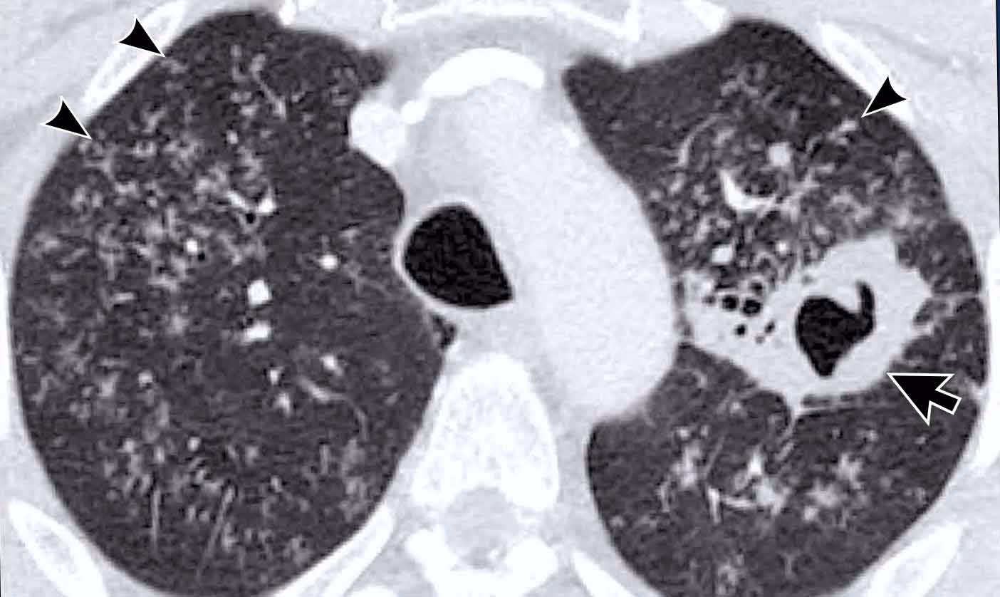 Can low-dose CT be used to detect TB?