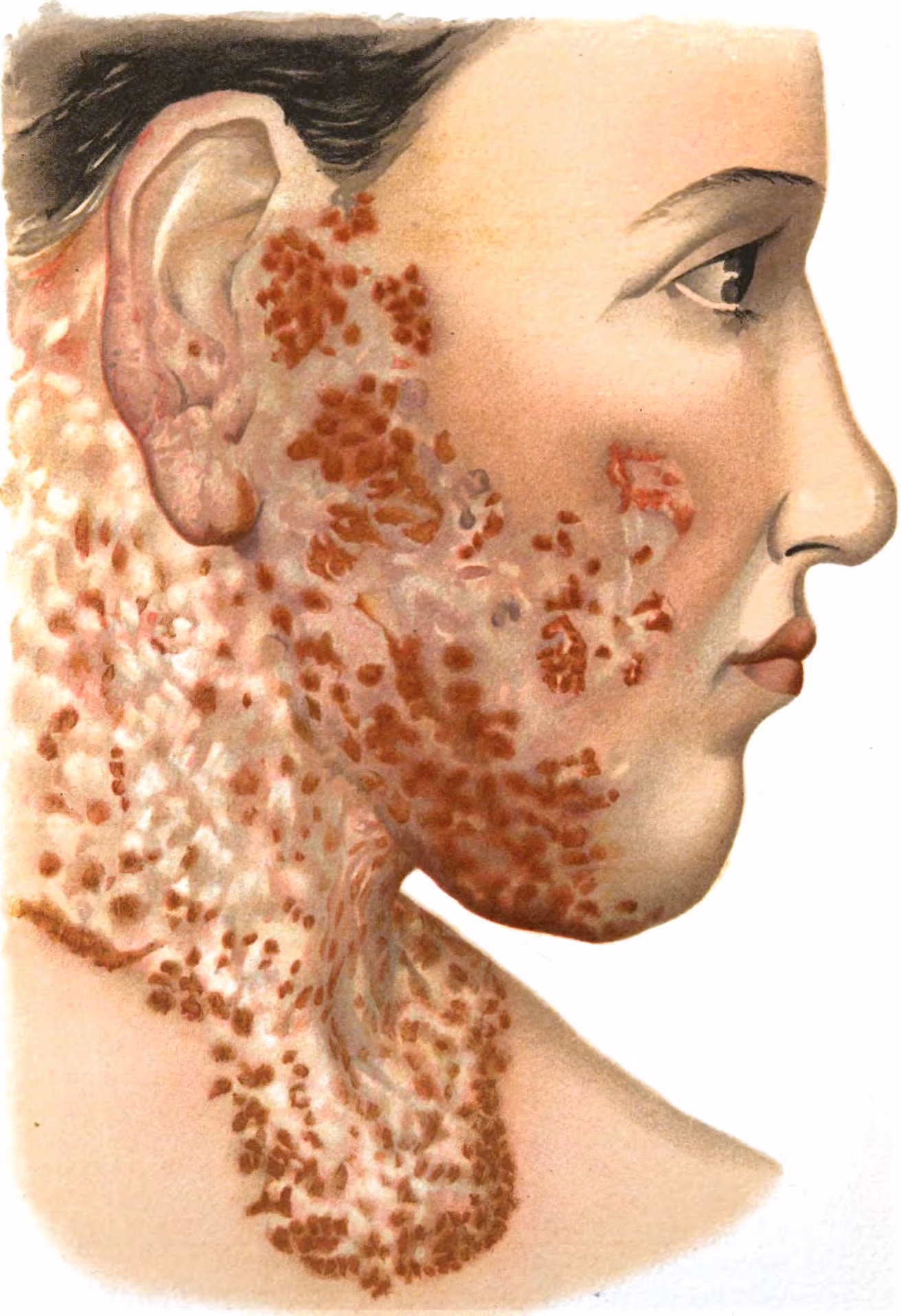 How is skin tuberculosis diagnosed?
