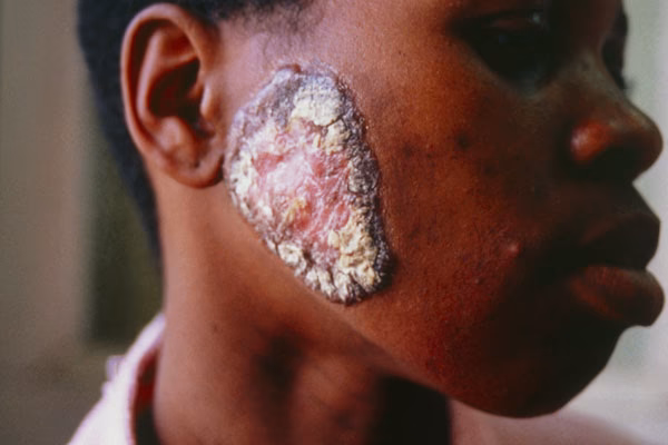 Can TB cause skin lesions?