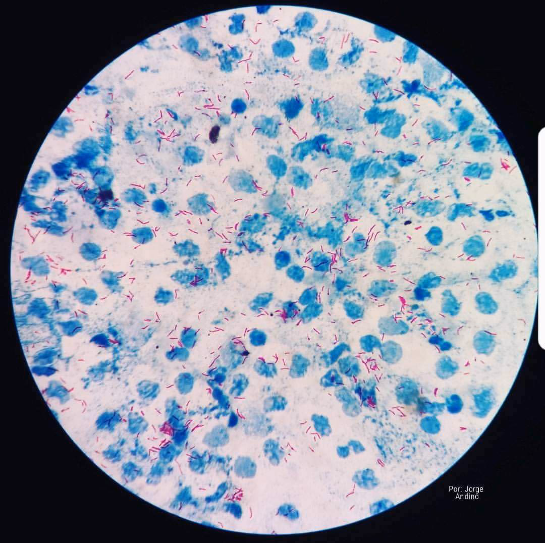 Are Mycobacterium tuberculosis acid-fast bacilli?