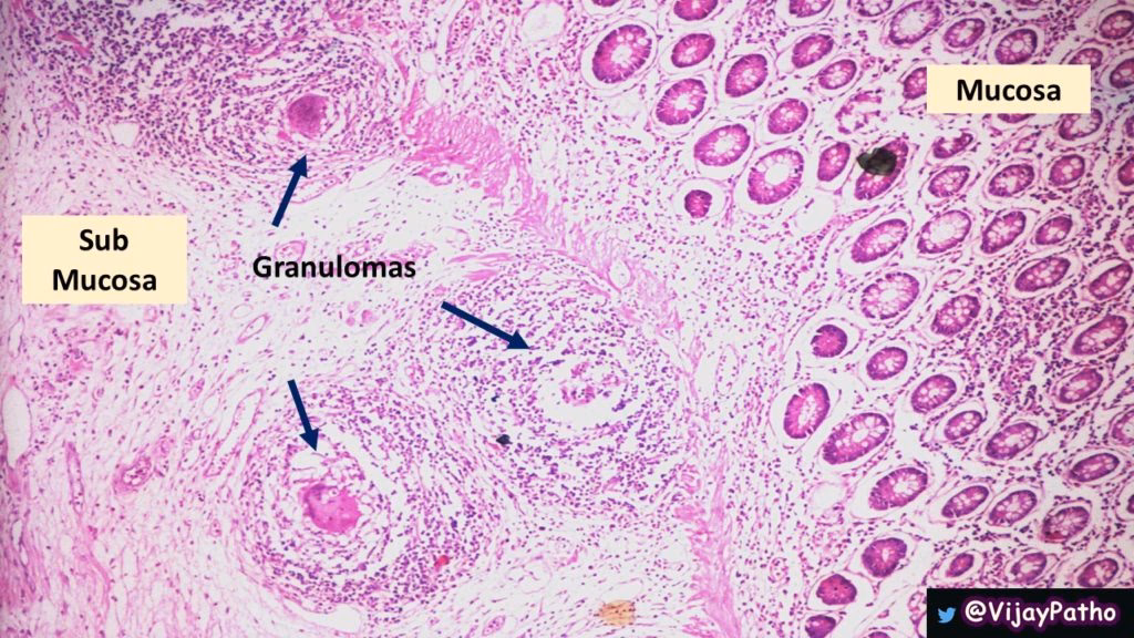 What stain is used to identify M tuberculosis (TB)?