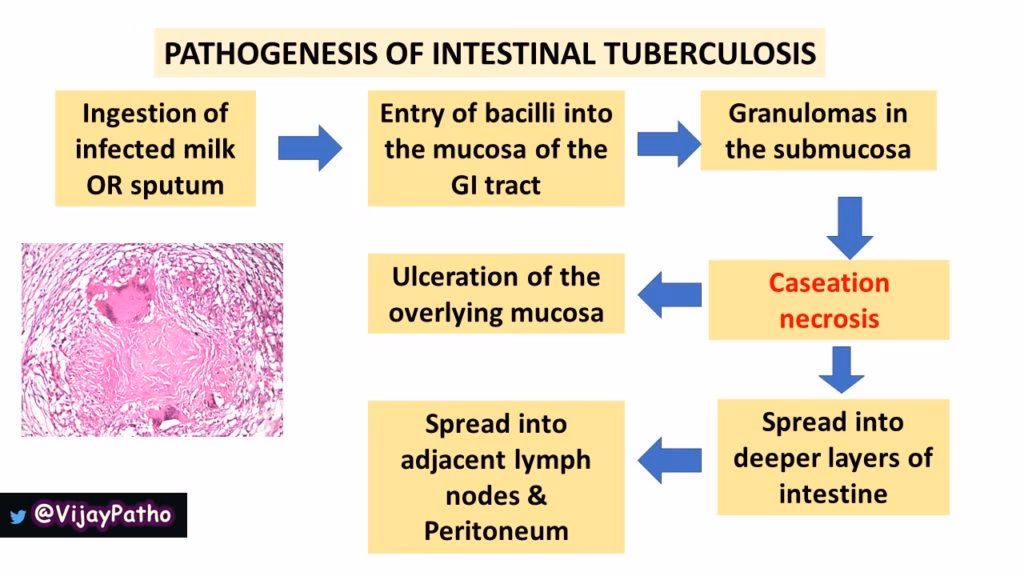 What is the pathophysiology of tuberculosis?