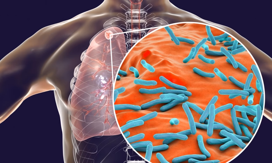 How many TB cases are there in Kansas?