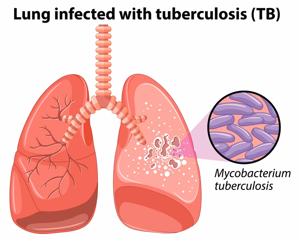 What causes pulmonary tuberculosis (TB)?