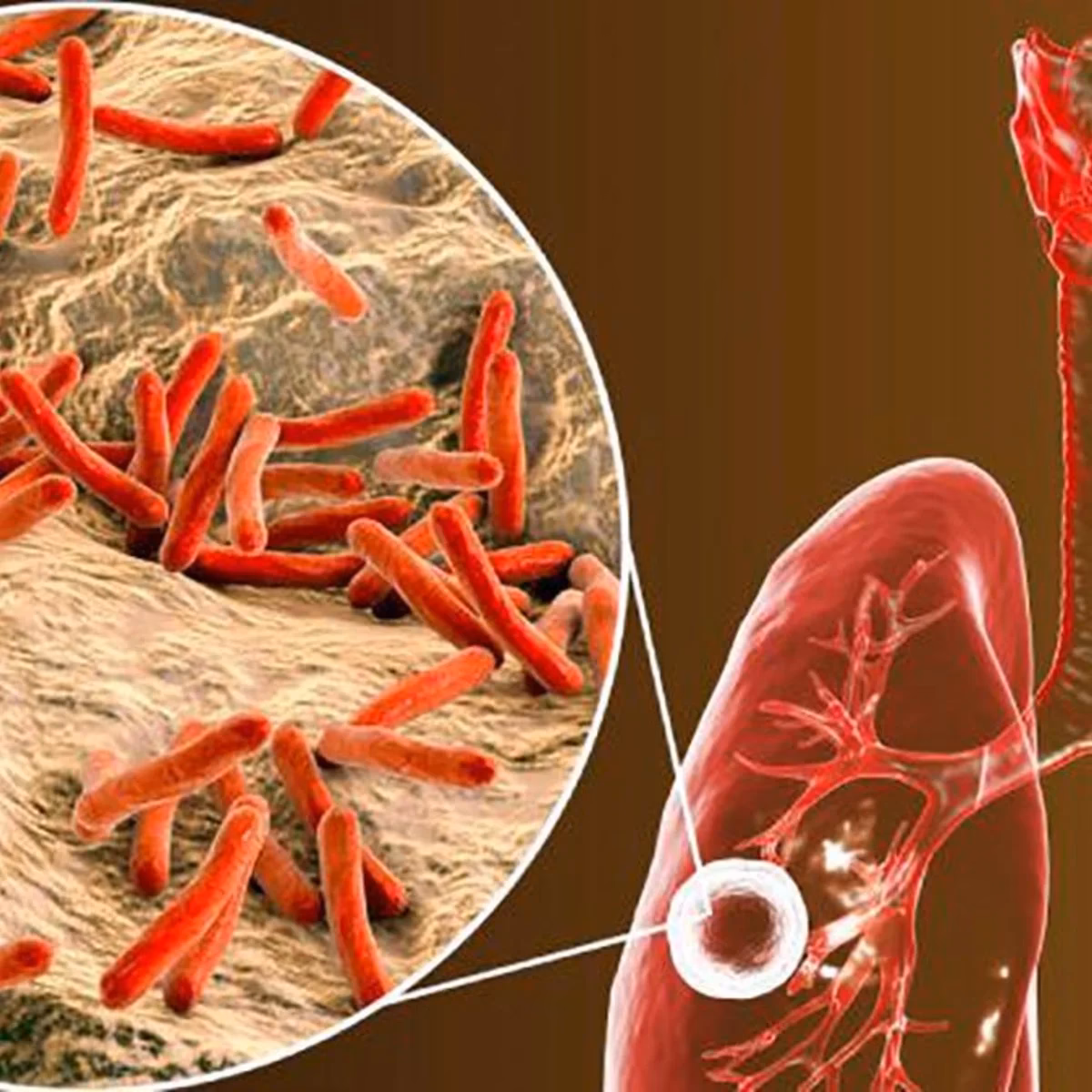 Are bronchitis and tuberculosis the same thing?