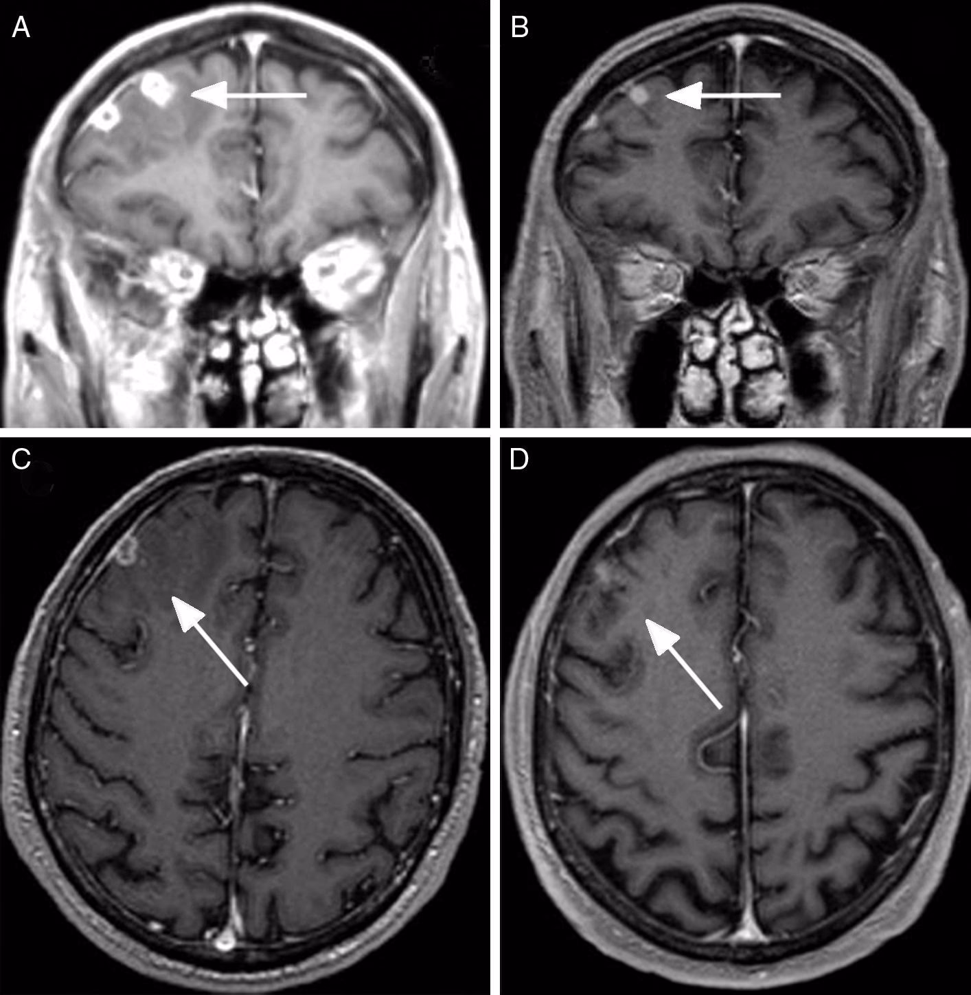 ¿Qué pasa si la tuberculina es negativa?