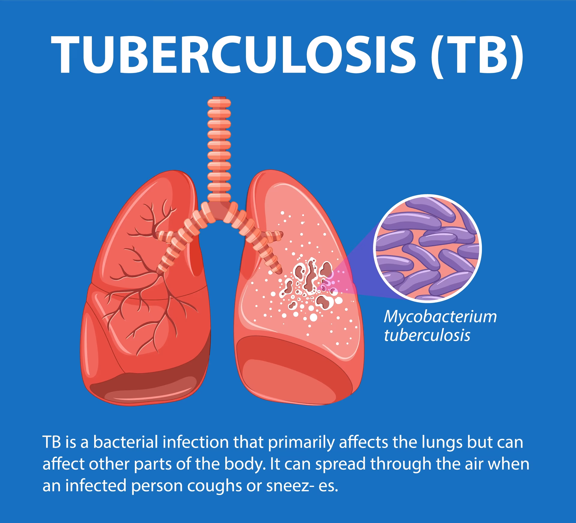 Does TB cause asthma & obstructive pulmonary diseases?