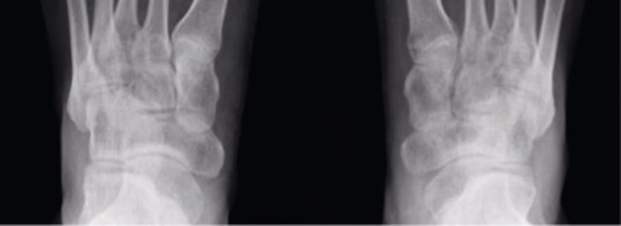 What is osteoarticular tuberculosis (TB)?