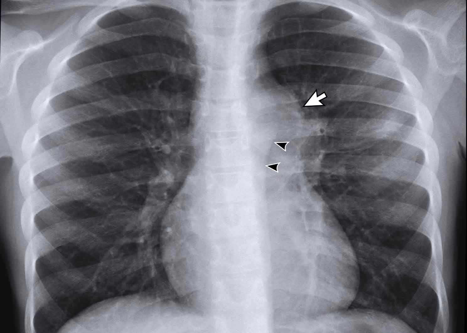 How is adult chest tuberculosis diagnosed?