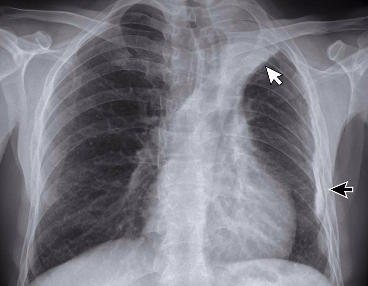 How can a doctor detect a TB infection?